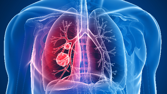 SCLC suffering lungs being highlighted in a medical diagram